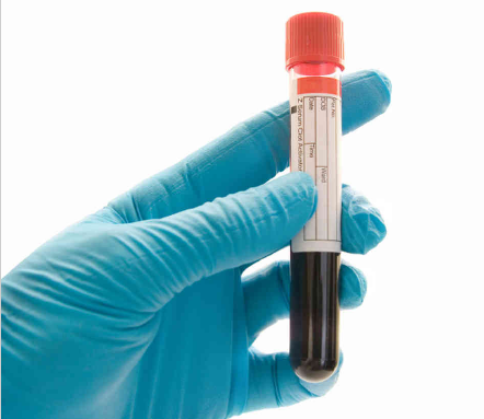 J Mol Med：新型血液检测手段提前诊断1型糖尿病